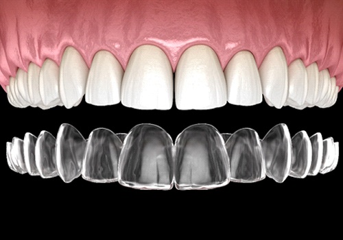 A digital image of a top row of teeth and an Invisalign aligner going on over these teeth