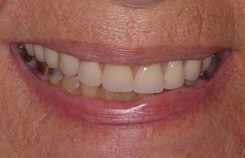 Perfected smile after dental restoration