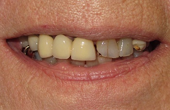 Smile with broken and decayed teeth before dental restoration