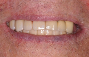 Perfected teeth and alignment after cosmetic dental treatment
