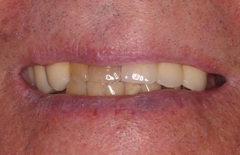 Yellowed and misaligned smile before cosmetic dental treatment