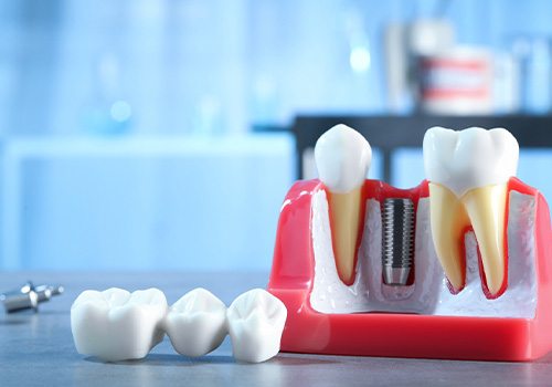 Sample dental bridge on tabletop next to model dental implant