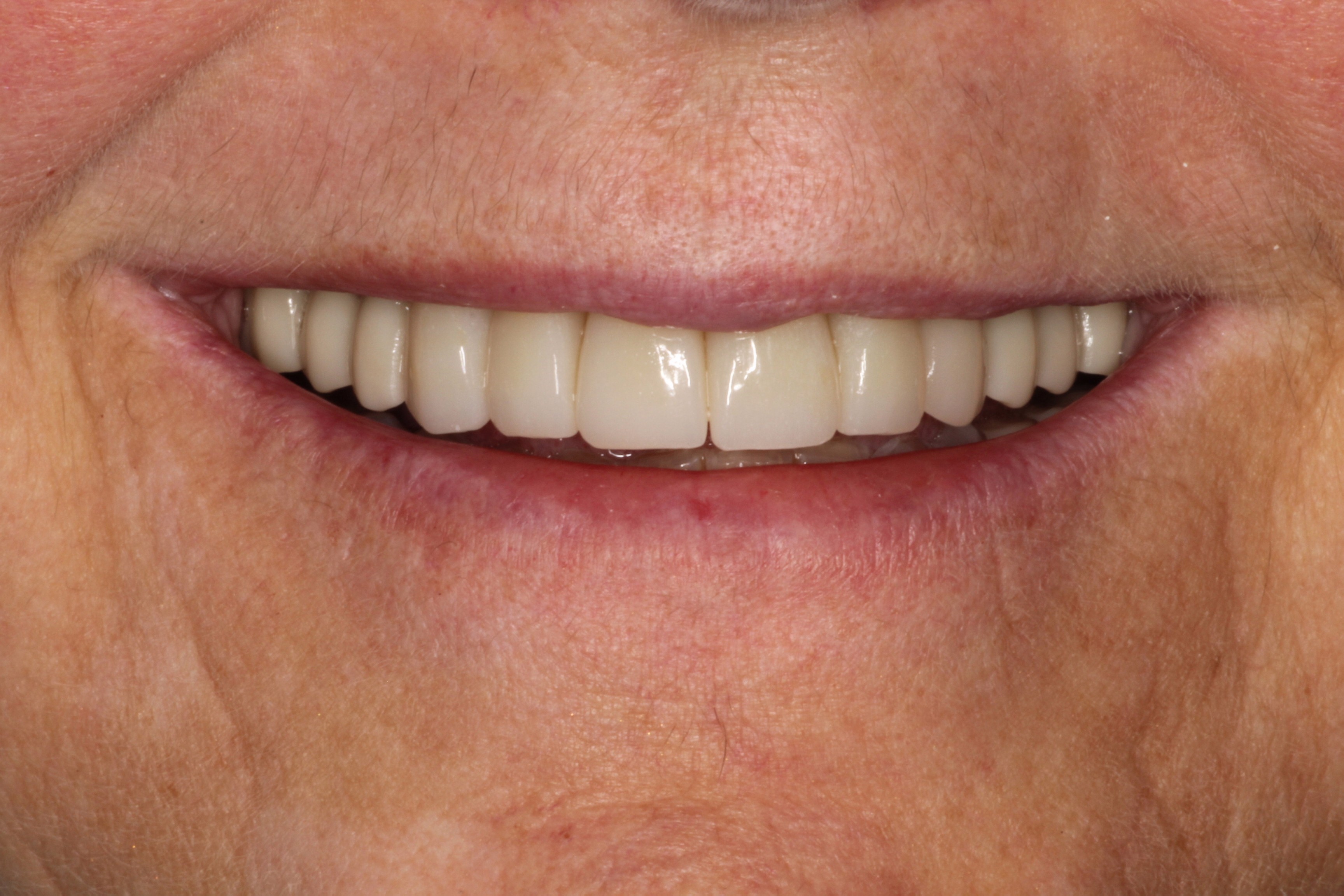 Healthy smile after restorative dentistry
