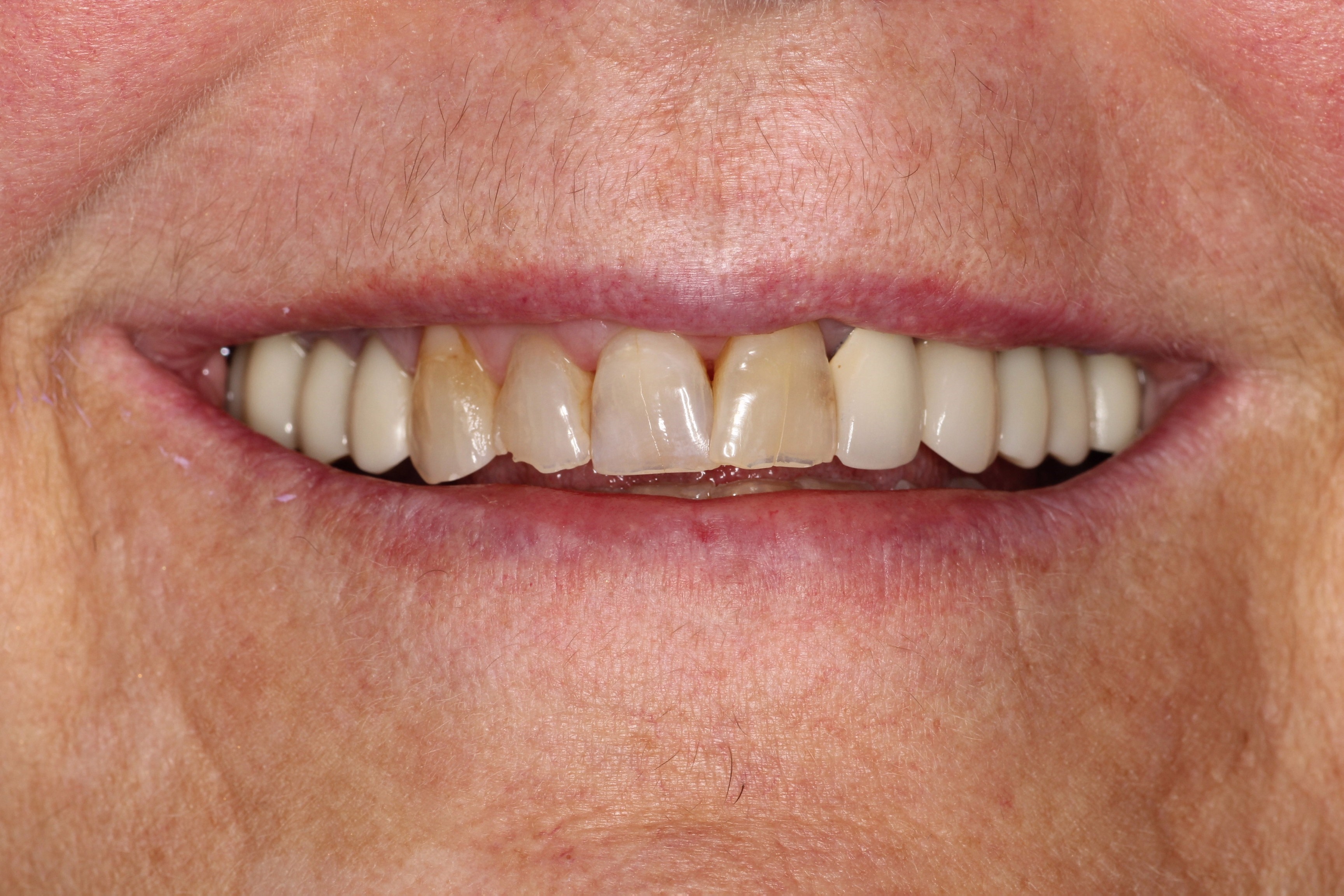 Discolored teeth before restorative dentistry