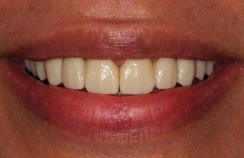 Flawless healthy smile after cosmetic dentistry