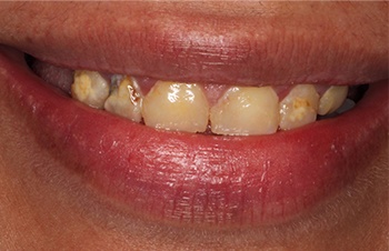 Yellowed decayed teeth before cosmetic dentistry