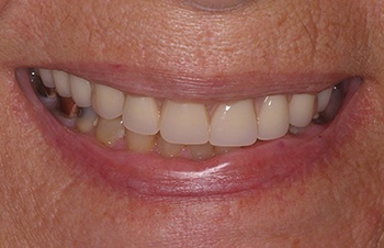 Perfected smile after dental restoration