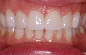 Brilliant smile after teeth whitening