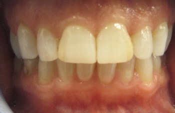 Yellow smile before teeth whitening