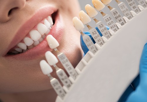 Closeup of smile compared with porcelain veneer color chart