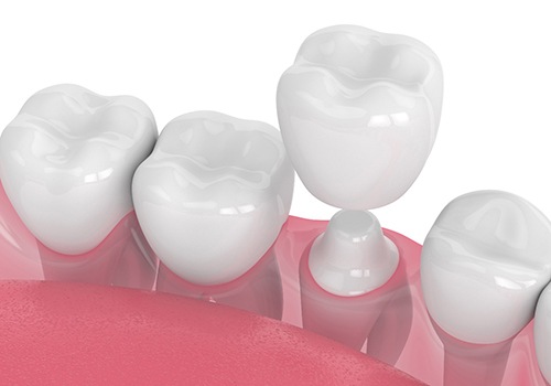 Illustration of dental crown being placed on molar