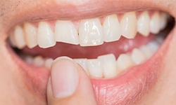 Closeup of smile with chipped front tooth