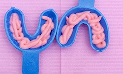 Fluoride treatment in blue trays