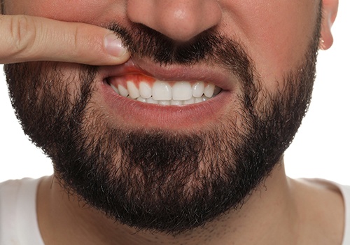Man pulling up lip to show signs of gum disease in San Antonio, TX