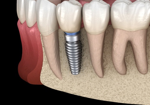 Diagram showing how dental implants in San Antonio integrate