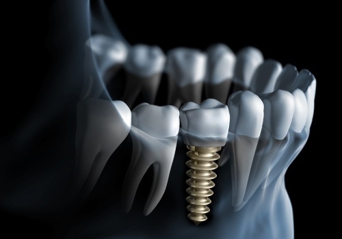 diagram of dental implants in San Antonio