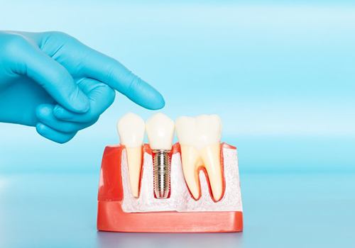 gloved hand pointing to model of dental implants in San Antonio