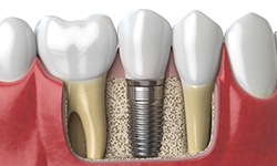 diagram of how dental implants in San Antonio work