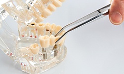 San Antonio implant dentist placing final restoration on model