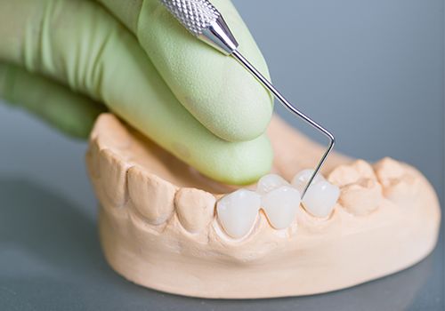 Model smile with dental bridge restoration