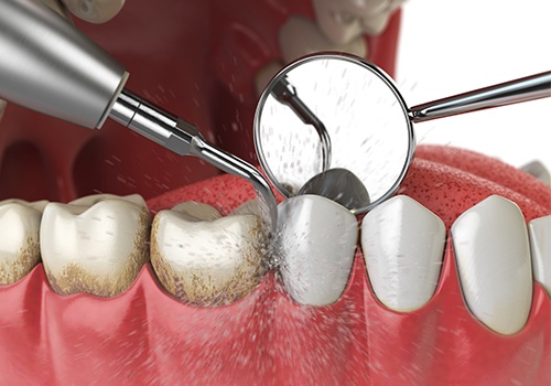 Animated periodontal maintenance treatment
