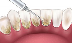 Digital image of scaling bacteria from the back of someone’s teeth