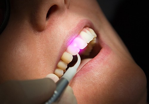 Closeup of soft tissue laser dentistry