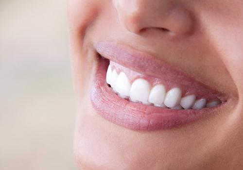 Closeup of smile with veneers in San Antonio