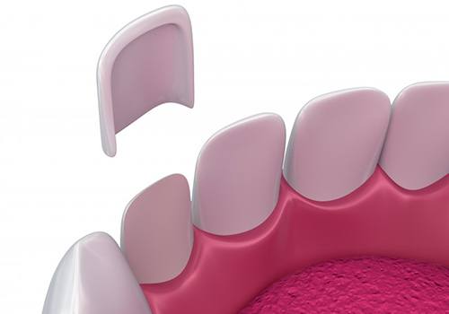 Diagram showing how veneers in San Antonio work