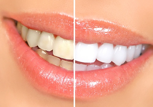 Before and after comparison of teeth whitening in San Antonio