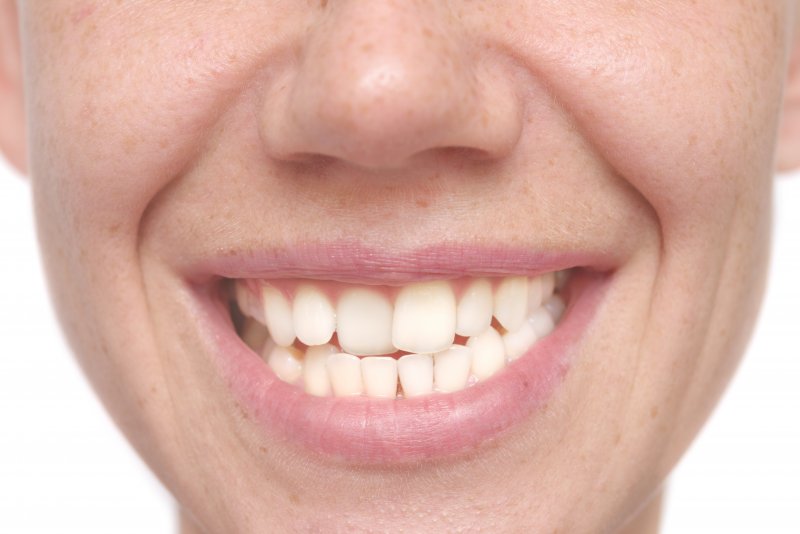 A person whose teeth have shifted in San Antonio