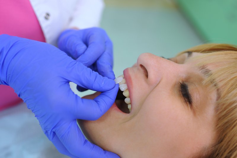 A dentist in San Antonio placing porcelain veneers