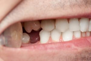 man showing his missing tooth toward the back of his mouth