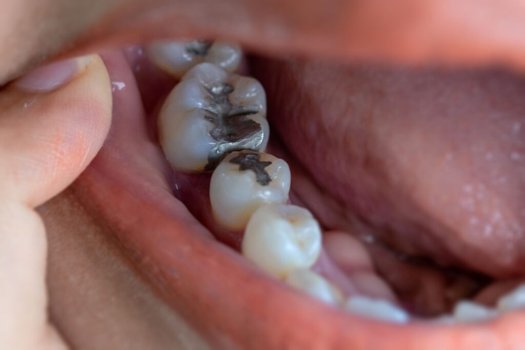 Closeup of finger pulling back lip to reveal several silver fillings in teeth